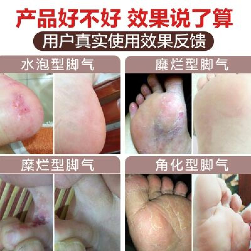 藏红花专治脚气