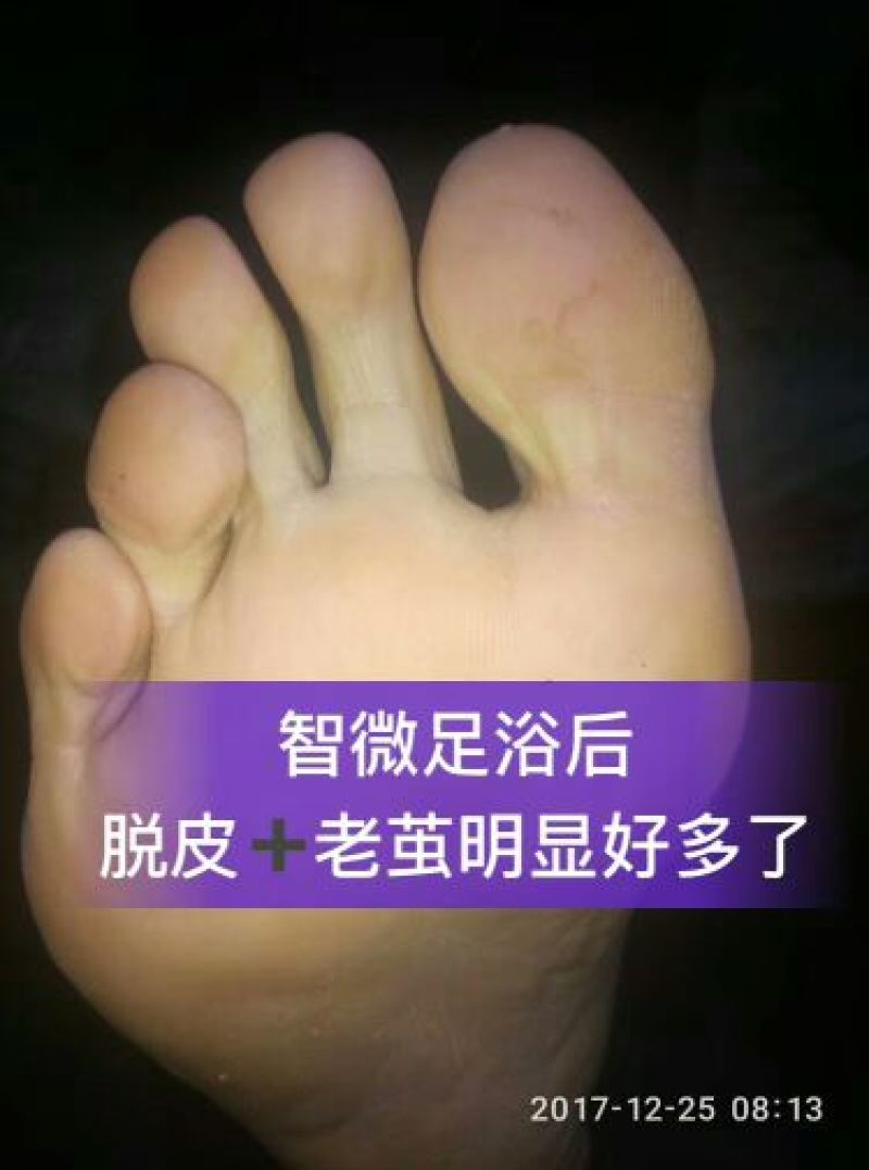 藏红花专治脚气