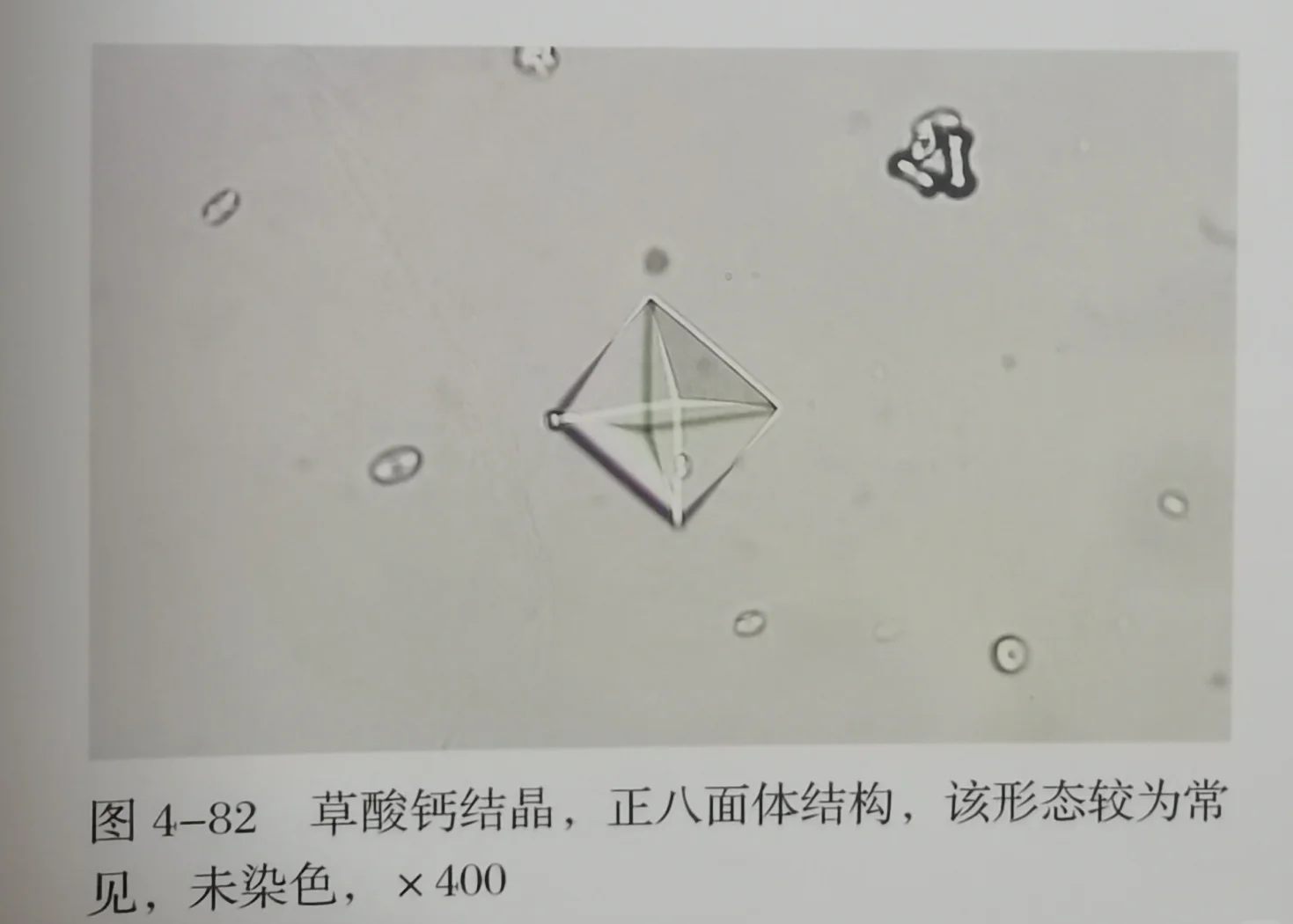 图示:左侧试管为西兰花汁+牛奶混合液,出现灰白色絮状沉淀(草酸钙);右侧试管为西兰花汁+无钙杏仁奶,溶液澄清。背景为显微镜下草酸钙结晶形态(菱形双锥体结构)与正常肠绒毛对比 西兰花与牛奶同食导致草酸钙沉淀示意图