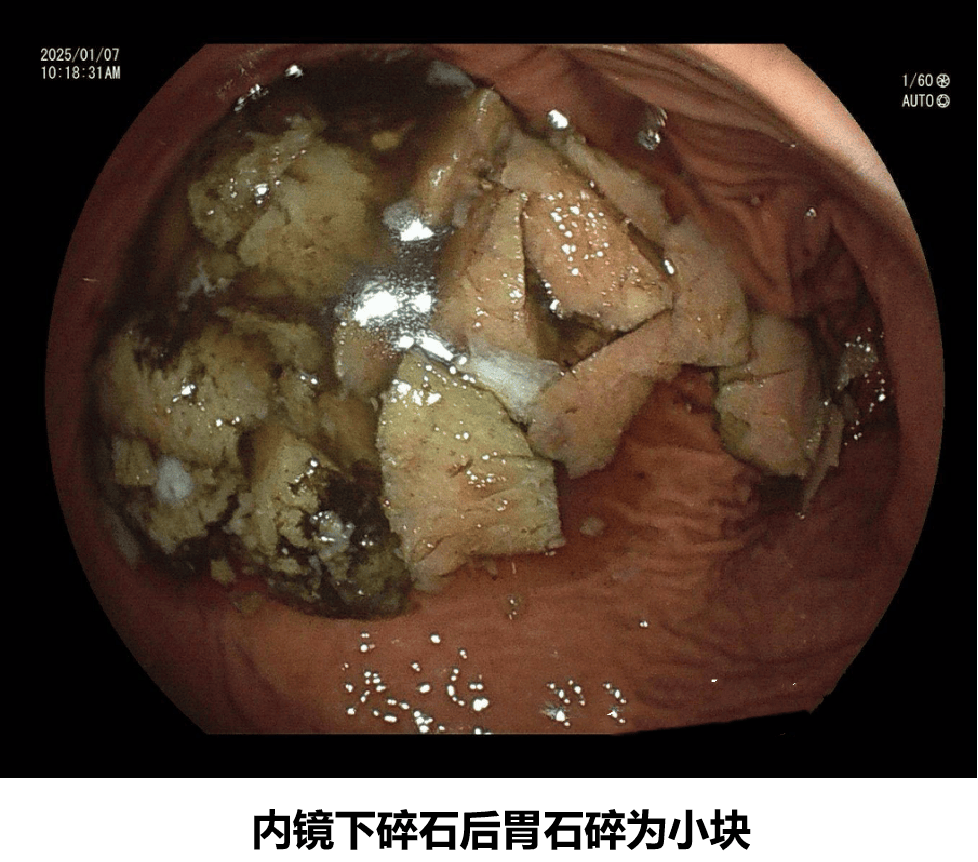 一张医学插图,展示胃内环境,胃壁分泌胃酸,食物中的鞣酸与蛋白质结合形成黑色团块状沉淀,逐渐聚集成圆形结石,附着于胃底部,旁边标注‘鞣酸+蛋白质+果胶→胃柿石’ 胃柿石形成机制示意图
