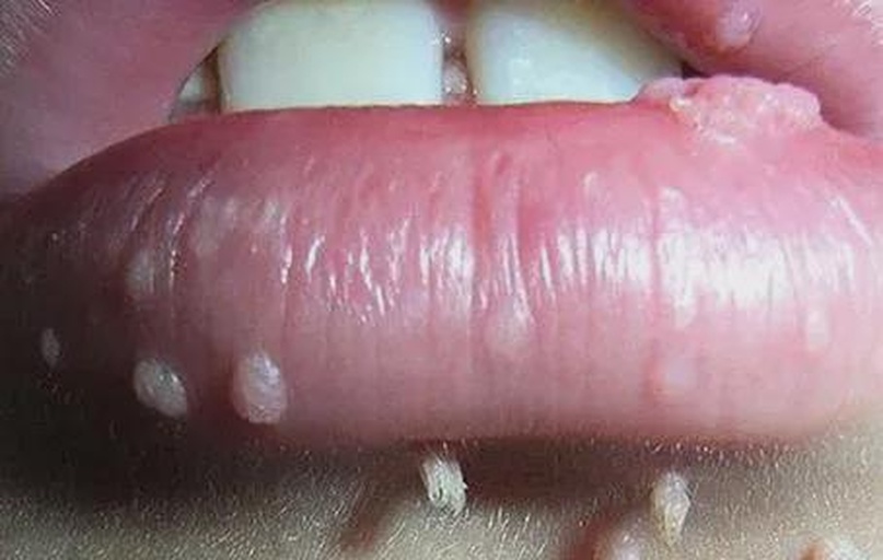 医学插画:香菜IgE介导过敏的典型局部反应,标注口唇、舌体、软腭三处易发部位,背景含显微镜下肥大细胞脱颗粒示意图 香菜过敏症状对比示意图:左侧为健康口腔黏膜,右侧为进食香菜后30分钟出现的唇周红肿、微小丘疹及舌体轻度肿胀
