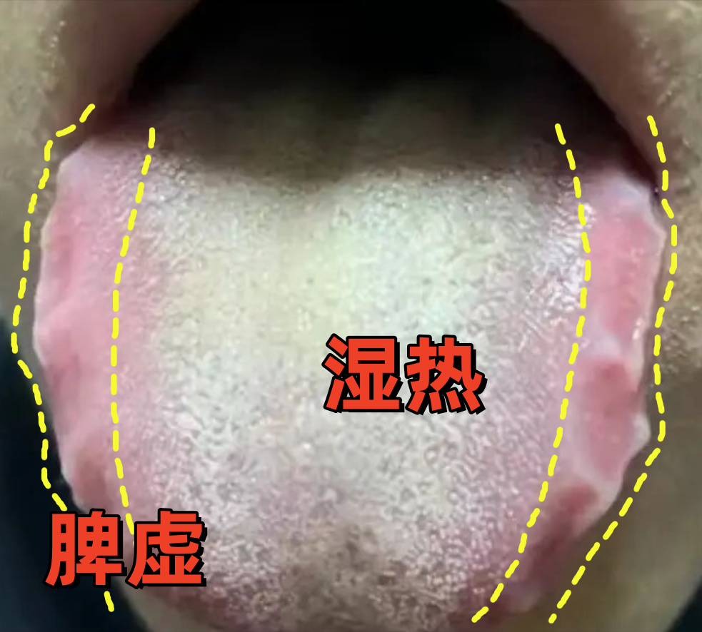 图示展示湿热体质常见特征,如面部油腻、舌苔黄腻、大便不成形等 湿热体质特征图