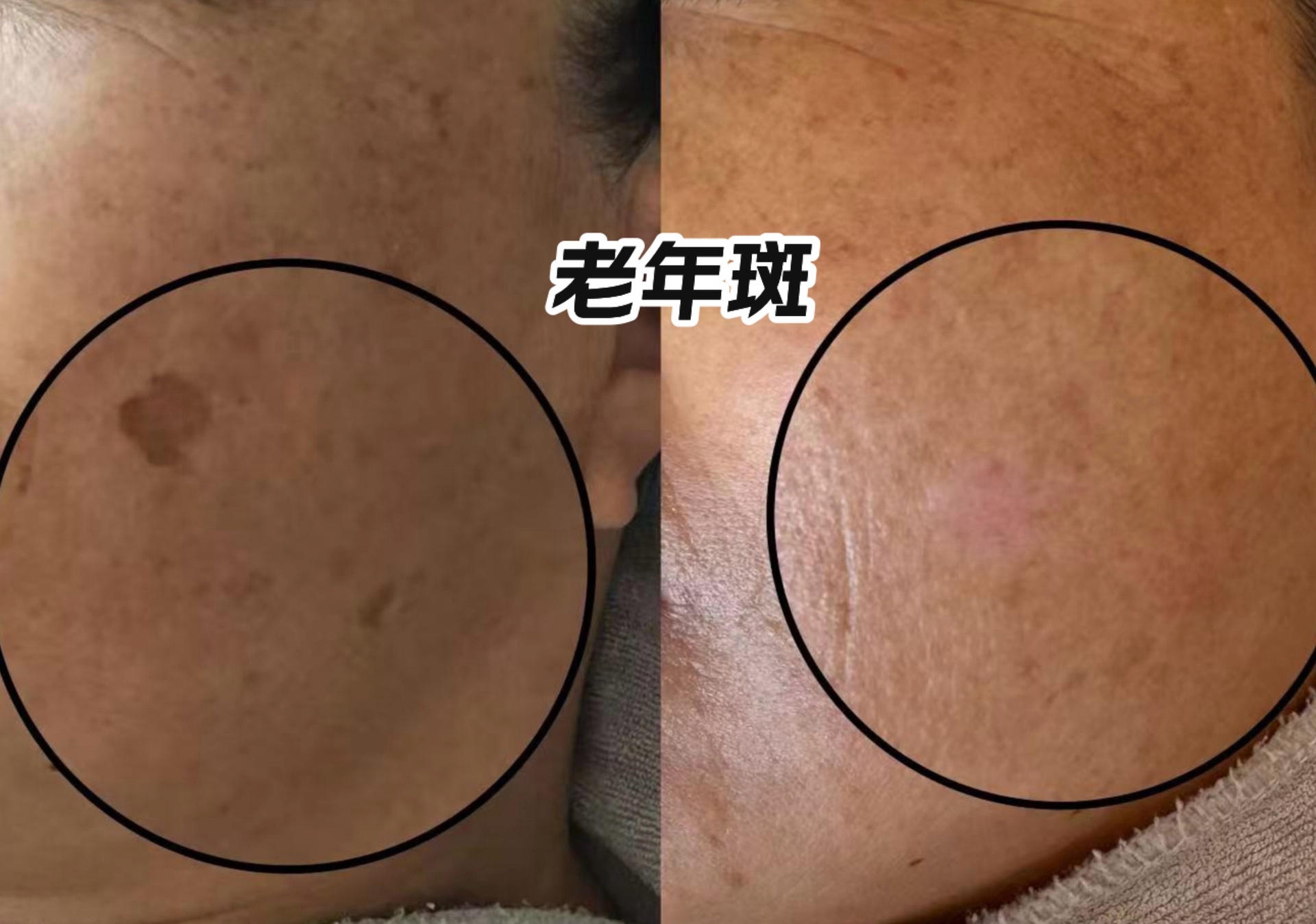 实验室场景：科研人员用共聚焦激光显微镜观测80岁受试者使用椴树蜜前后角质层结构变化，屏幕显示处理后角质细胞排列更致密，细胞间隙荧光标记明显减少