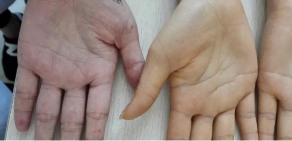 临床鉴别示意图:清晰对比胡萝卜素血症与病理性黄疸的皮肤/巩膜表现差异,强调‘巩膜是否发黄’为黄金鉴别标准 三组对比图:左为正常肤色手掌,中为胡萝卜素血症典型掌心黄染(无巩膜黄染),右为肝细胞性黄疸患者巩膜+皮肤同步黄染,三者并列标注关键鉴别点