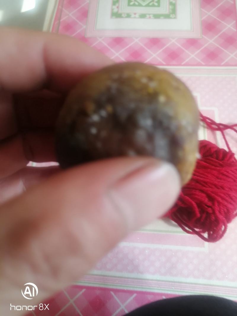 我家里有个猪胆结石