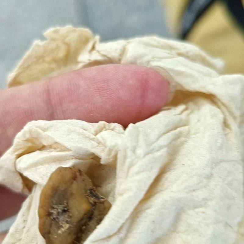鹅宝（鹅结石）